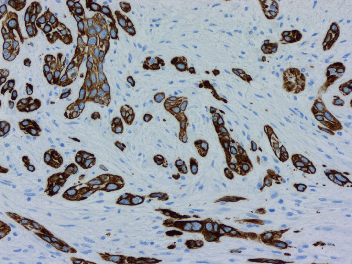 Bauchspeicheldrüsenkrebs: Neuer Ansatz bei Therapieresistenzen | Bosch